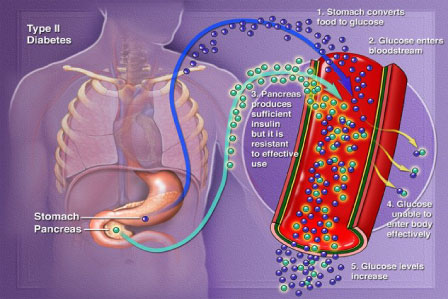 <strong>Diabetes Types</strong>